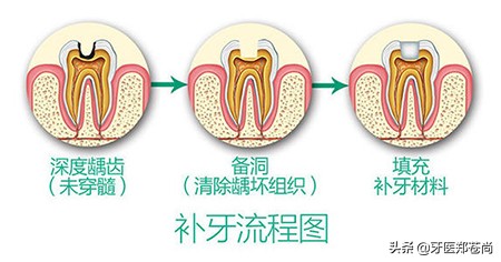 拔掉蛀牙后多久能正常饮食,蛀牙补了以后能维持几年