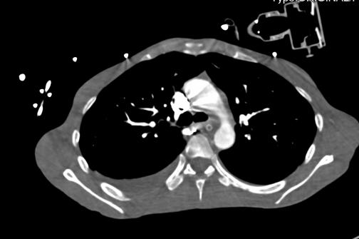 重度高碳酸血症突出表现,出现消化系统疾病的临床表现