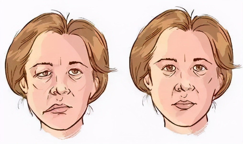 突然嘴巴歪哪里能治,怎么突然嘴巴肿起来了