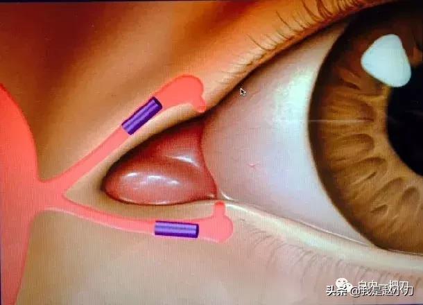 干眼症中医治疗好还是西医治疗好,干燥综合症引起的干眼症怎么治疗