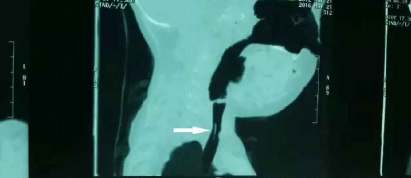 小孩吃东西卡住正确处理方法,小孩吃东西卡住急救视频教学