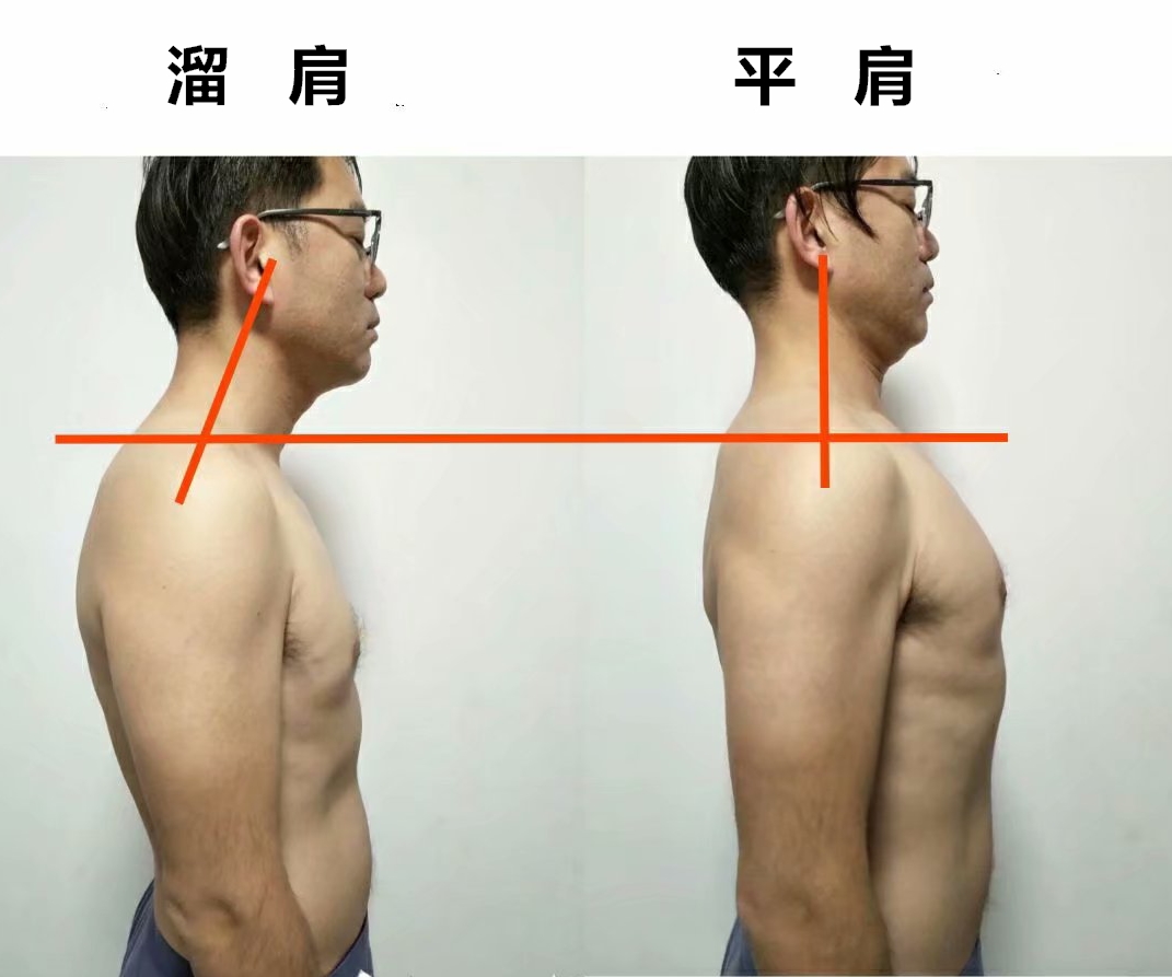 溜肩，长得再瘦体型也垮垮的。但溜肩常见这两种情况，别练错