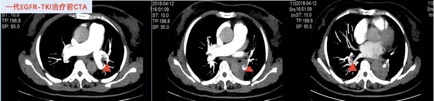 口服长春瑞滨出现耐药性了,口服长春瑞滨要吃多久