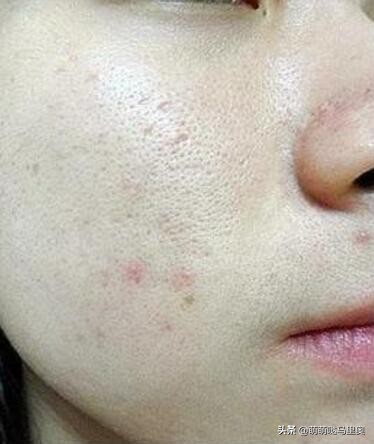 脸上的毛孔像一个个坑,用这2招来“补救”,毛孔近看也看不见