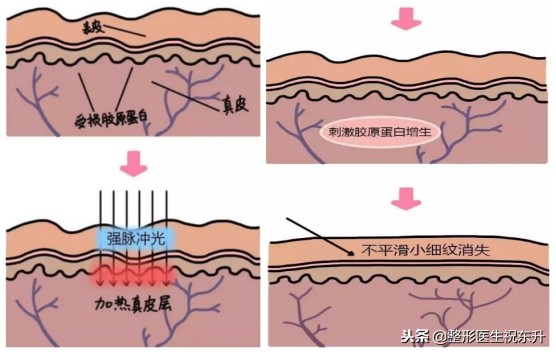 光子嫩肤敏感皮肤能做吗,光子嫩肤做了皮肤敏感