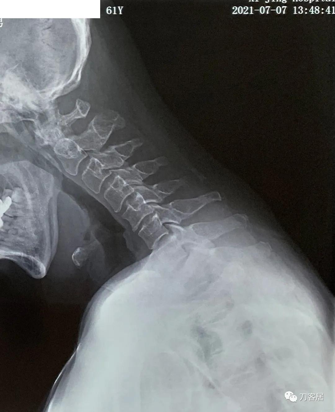 病例左侧躯体麻木,右侧肢体麻木典型病例