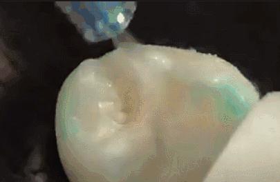 窝沟封闭适合几岁孩子做,在家给娃做窝沟封闭