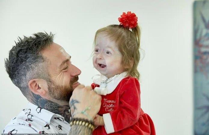 2岁女孩基因突变长得像80岁老人,2个孩子患罕见遗传病