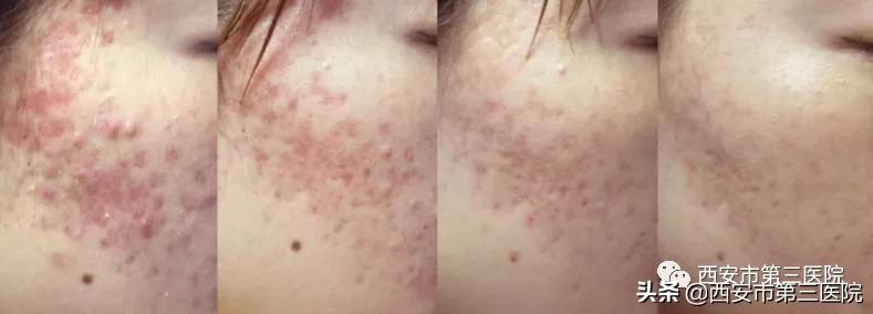 光子嫩肤的魅力,光子嫩肤带你美下去