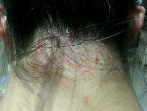 头部严重脂溢性皮炎公认药,脂溢性皮炎用什么洗头最好