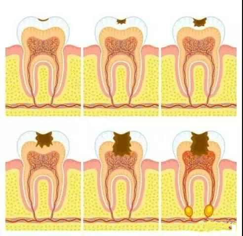 牙齿上面有黑线但是没有洞怎么办,牙齿咬合面有黑线没有洞怎么治疗