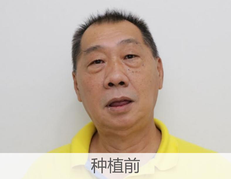 做烤瓷牙如何磨老牙教程,烤瓷牙的正确磨法