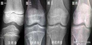 跳高之星身高体重,跳高冠军长高秘籍