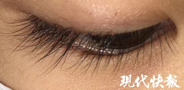 5岁女孩总说眼睛痒，扒开一看竟有二十多只活虱子，十几个虫卵