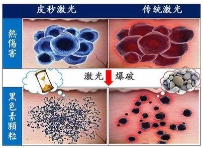 为什么皮秒后反而长出更多的斑,皮秒后为啥斑越来越明显