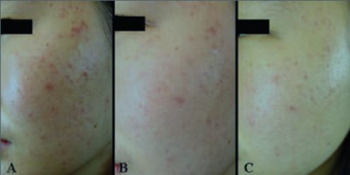 不同痘坑凹洞擦什么药膏,不同痘坑怎么修复