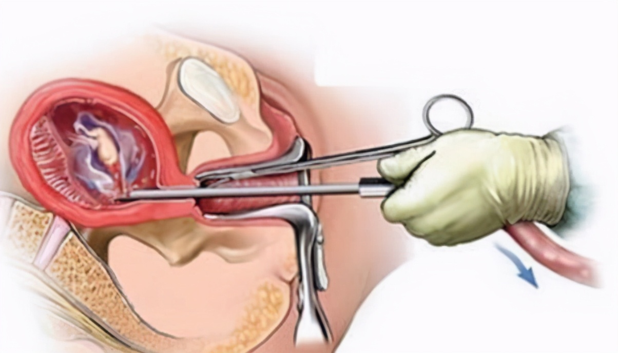 12周流产最佳方式,早孕最好的流产方式