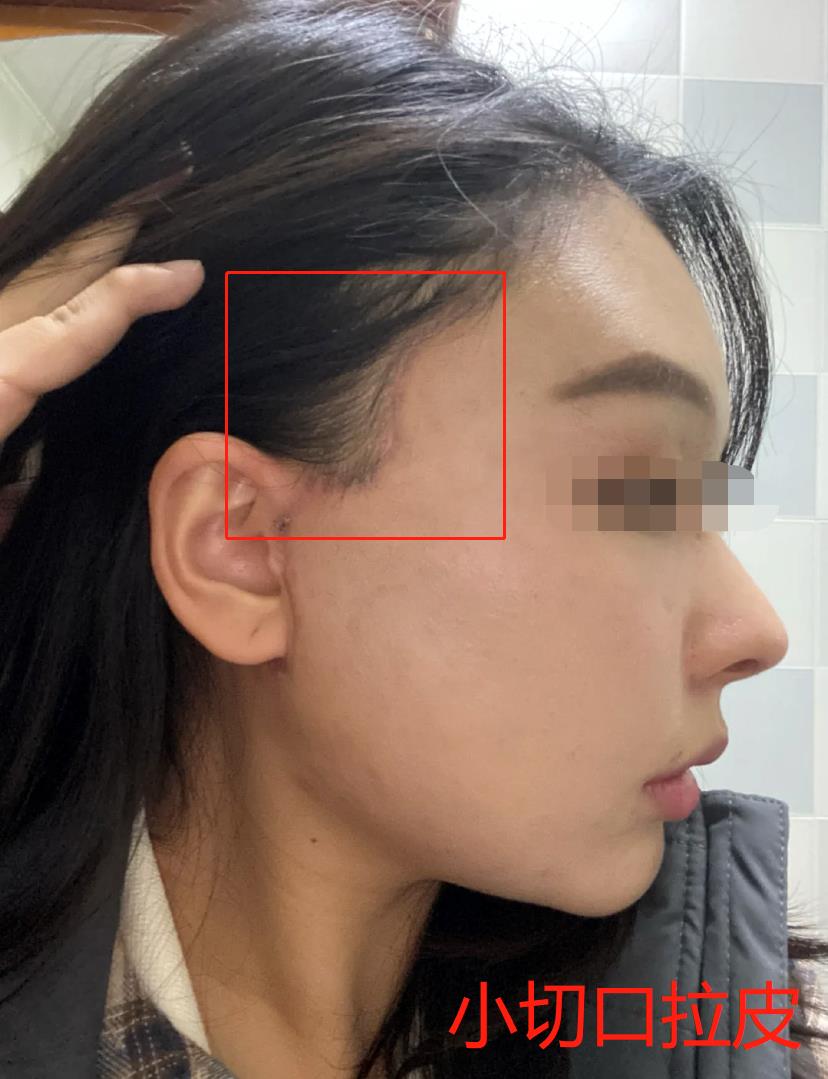 小切口拉皮和筋膜折叠哪种效果好,筋膜提升和剥离大拉皮的区别