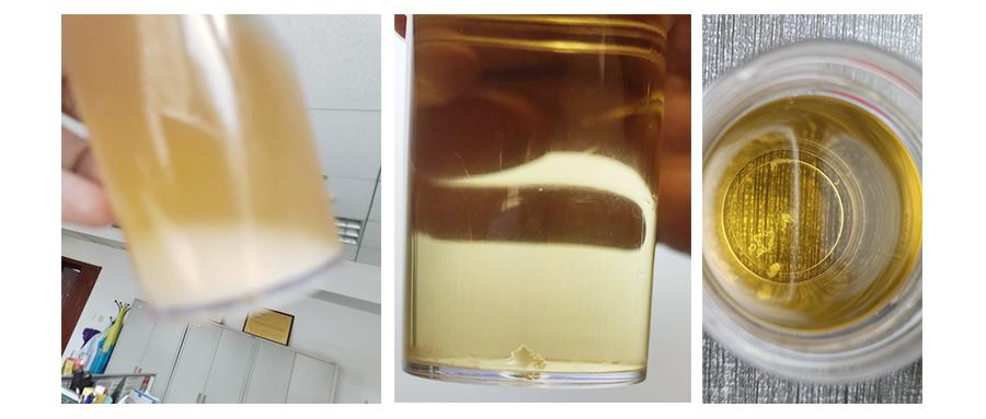 前列腺炎检查结果严重症状少,男士尿常规检查出慢性前列腺炎