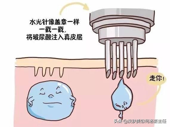 无针水光涂抹式,注射式