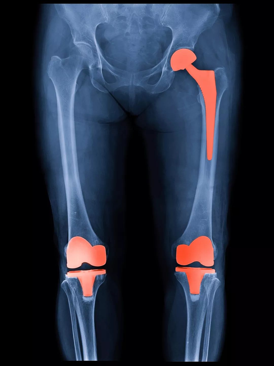 腿疼膝盖骨刺的最快解决方法,膝盖骨刺关节炎疼痛解决最好办法