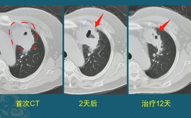 化脓性肺炎，硬扛3天不吃抗生素必后悔，这个细菌专治各种不服