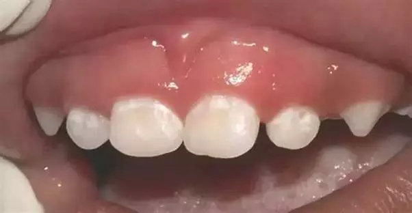 牙齿脱矿涂氟多久可以恢复,牙齿脱矿白斑能自己恢复吗