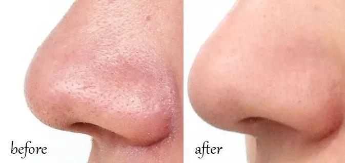 黑头闻起来很臭,黑头很痛怎么回事