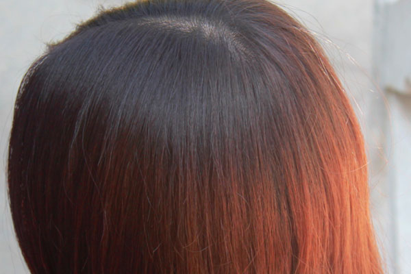 为什么头皮里会长粉刺痘痘,为什么头皮上长痘痘还掉发