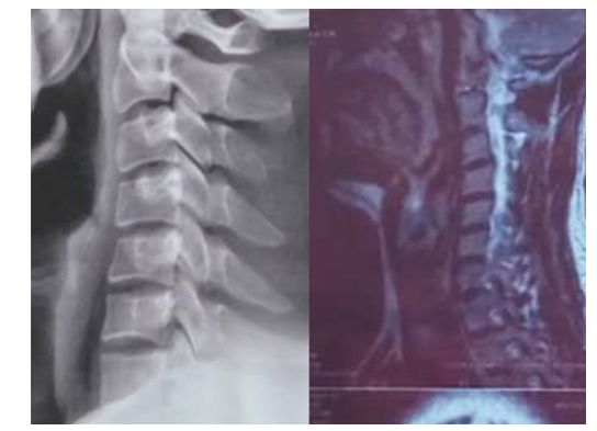 颈椎曲度没问题会椎间盘突出么,正常的颈椎曲度是什么样的