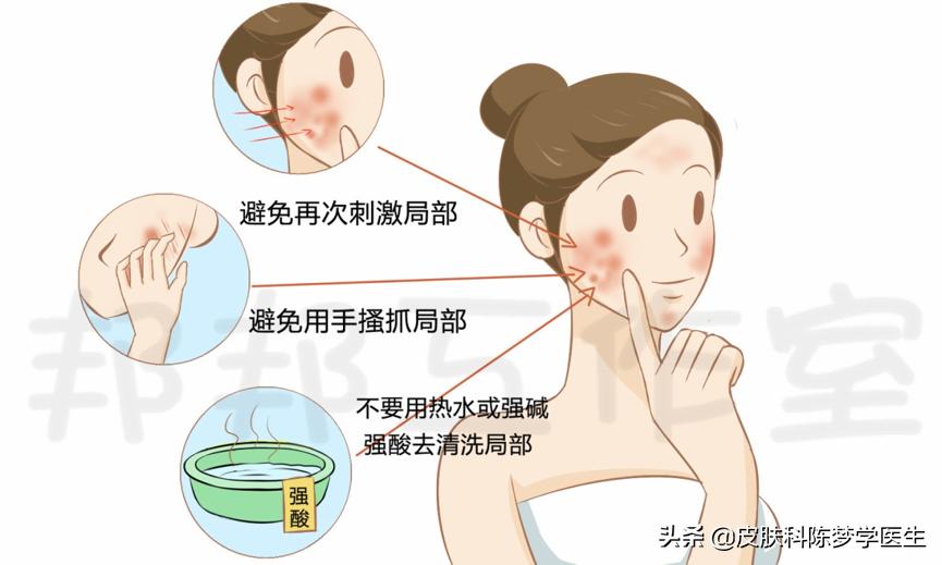 湿疹去药店买什么药擦比较好,药房可买到的没有激素的湿疹药膏