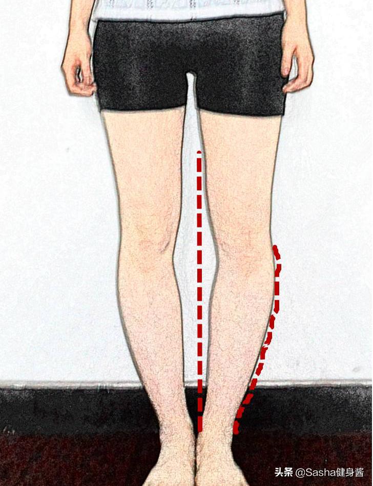 严重o型腿怎么矫正最有效的动作,正确矫正o型腿的方法