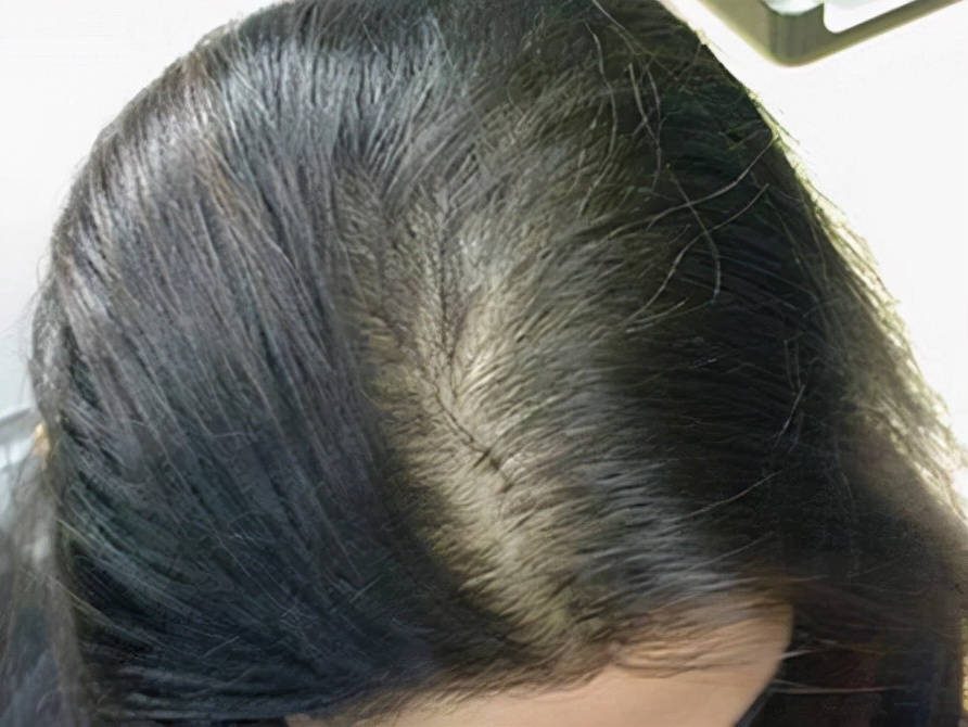 每天吃叶酸身体会有什么变化,坚持吃叶酸片有什么副作用