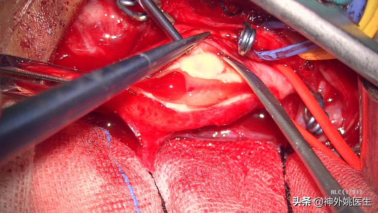 颈内动脉狭窄内膜剥脱术风险大吗,颈动脉内膜摘除手术