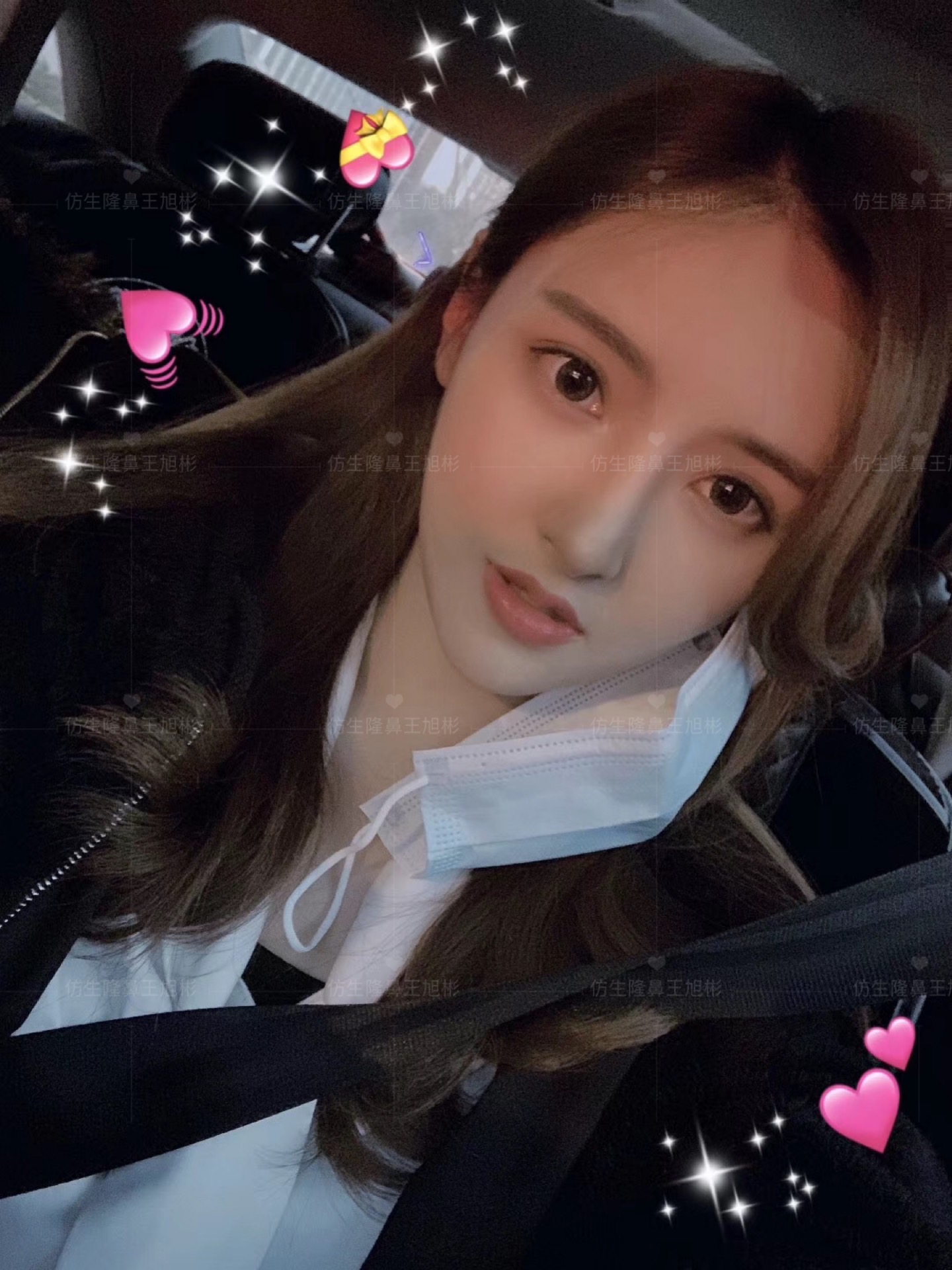 线雕隆鼻后鼻综合修复术,隆鼻失败修复手术真实案例