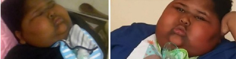 小胖威利查染色体还是基因,小胖威利症是遗传病吗