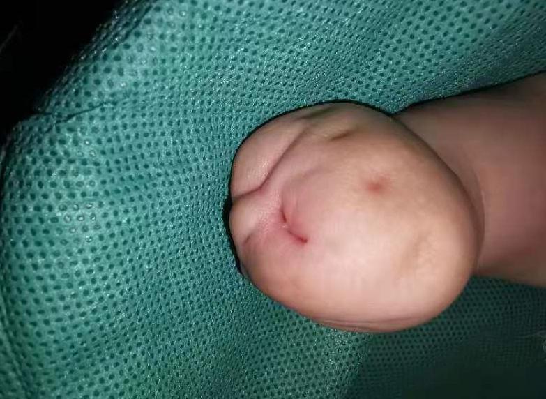 并指畸形免植皮案例,并指畸形