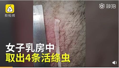 小孩子睫毛感染阴虱,杭州六岁孩子睫毛长阴虱