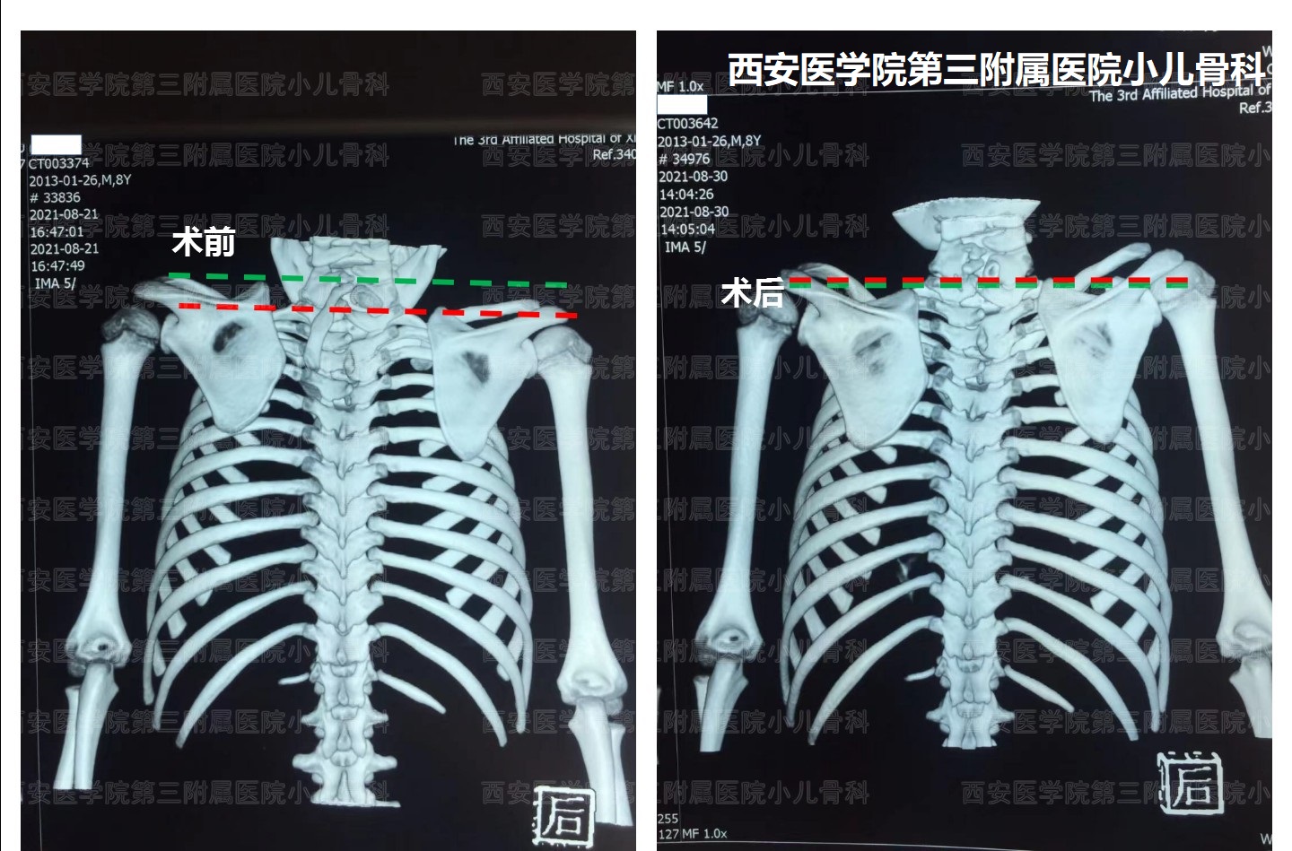 先天性高肩胛手术,先天性肩胛症通过手术需要多少钱
