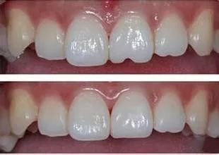 乳牙磕瓜子恒牙为什么变瓜子牙了,爱嗑瓜子