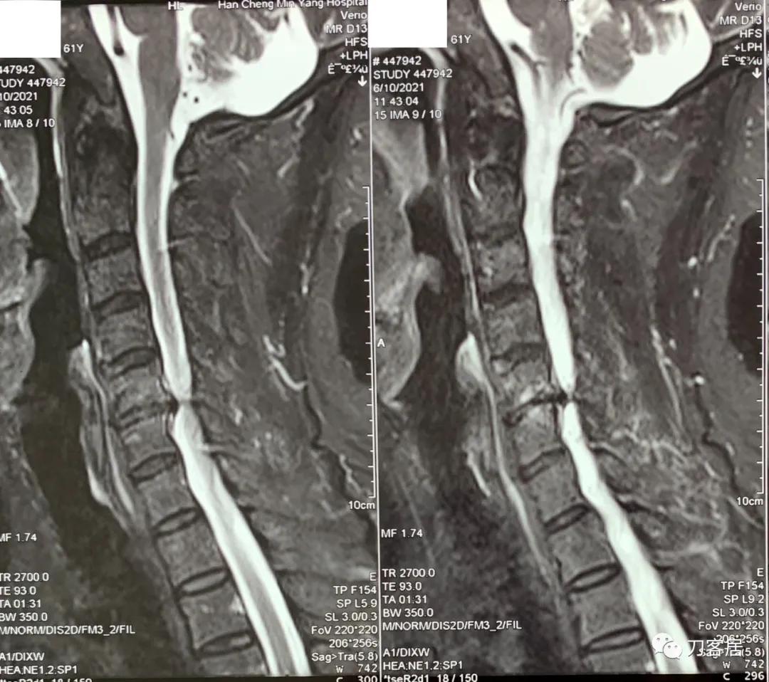 病例左侧躯体麻木,右侧肢体麻木典型病例