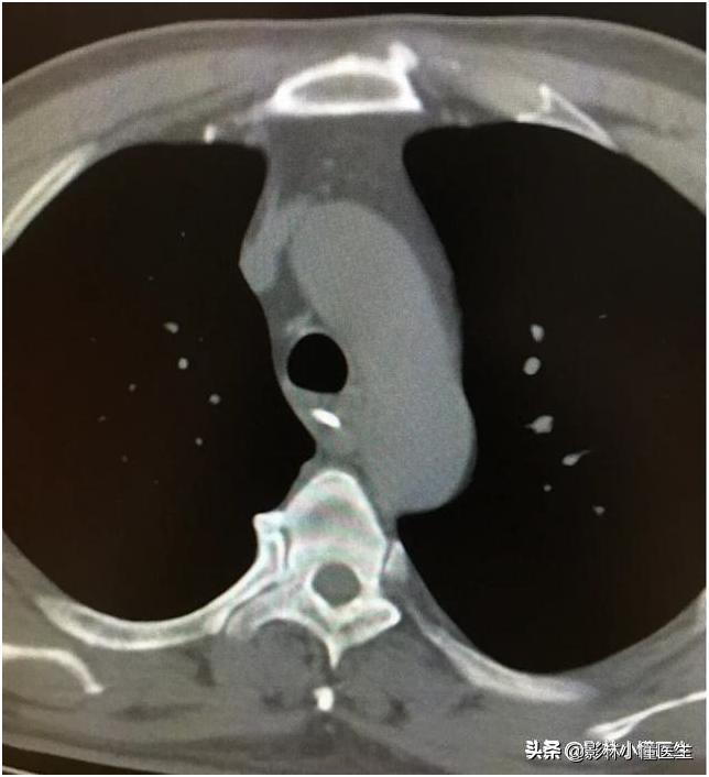 误吞假牙吃什么有助于排出,误吞假牙怎么处理