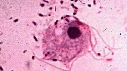 女性阴道炎怎么办？做好这些事，远离难“炎”之隐