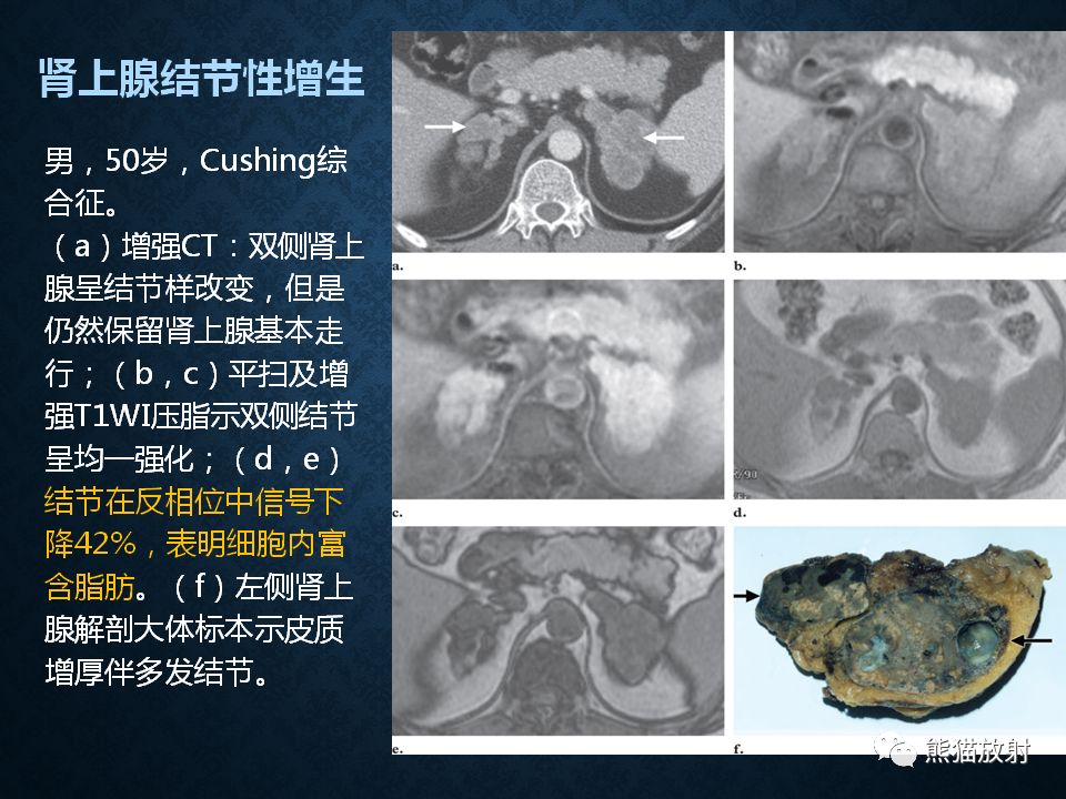纵隔和肾上腺恶性肿瘤,纵隔性肿瘤位置图