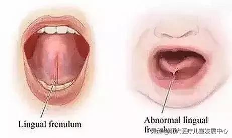 小孩舌系带剪得太多了怎么办,孩子舌系带剪了不能翘舌