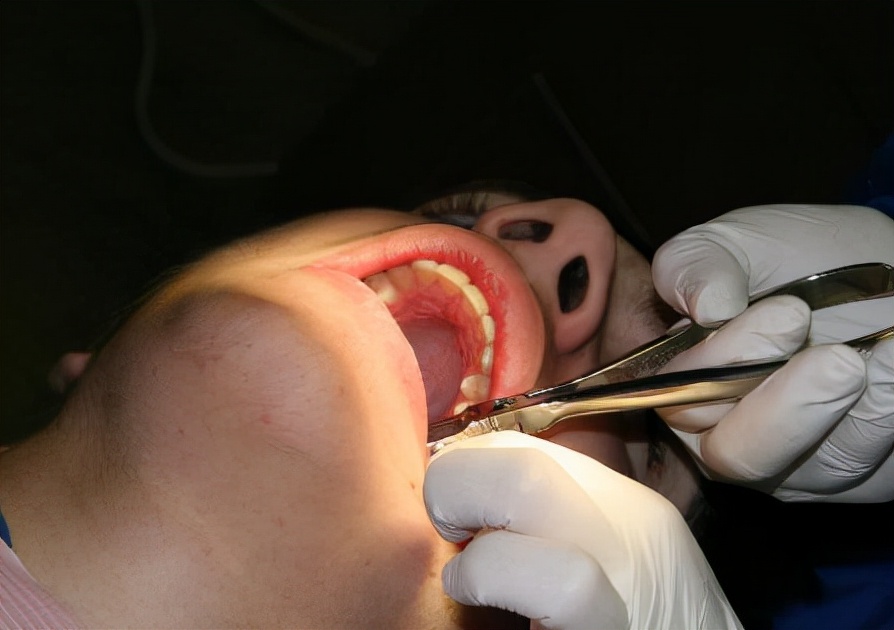 拔智齿后你需要注意的地方,拔了智齿缝针拆完线怎么护理