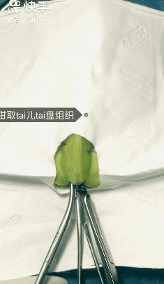 我在快手上看人切洋葱，竟然弄懂了剖腹产？