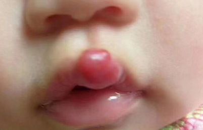 宝宝有一块红胎记是血管瘤吗,新生儿红胎记正常吗