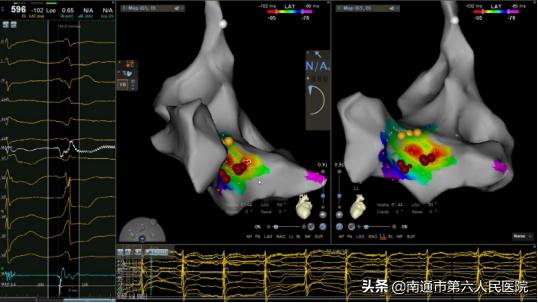 72岁老人室性早搏心率40次,老年人心脏早搏24小时二百多次