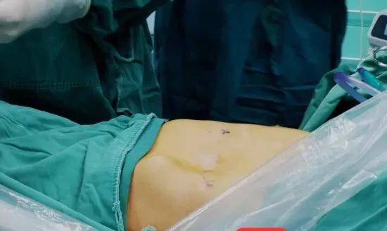 漏斗胸手术后变沟状胸,胸部饱满手术